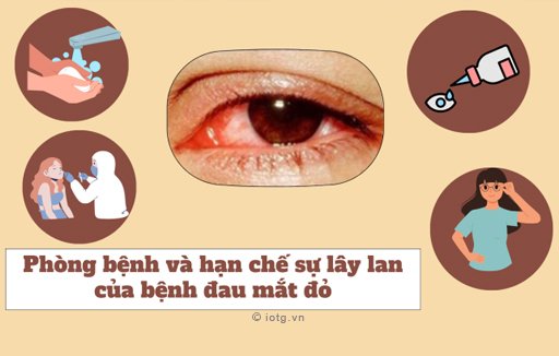 Cách phòng tránh lây lan của bệnh đau mắt đỏ